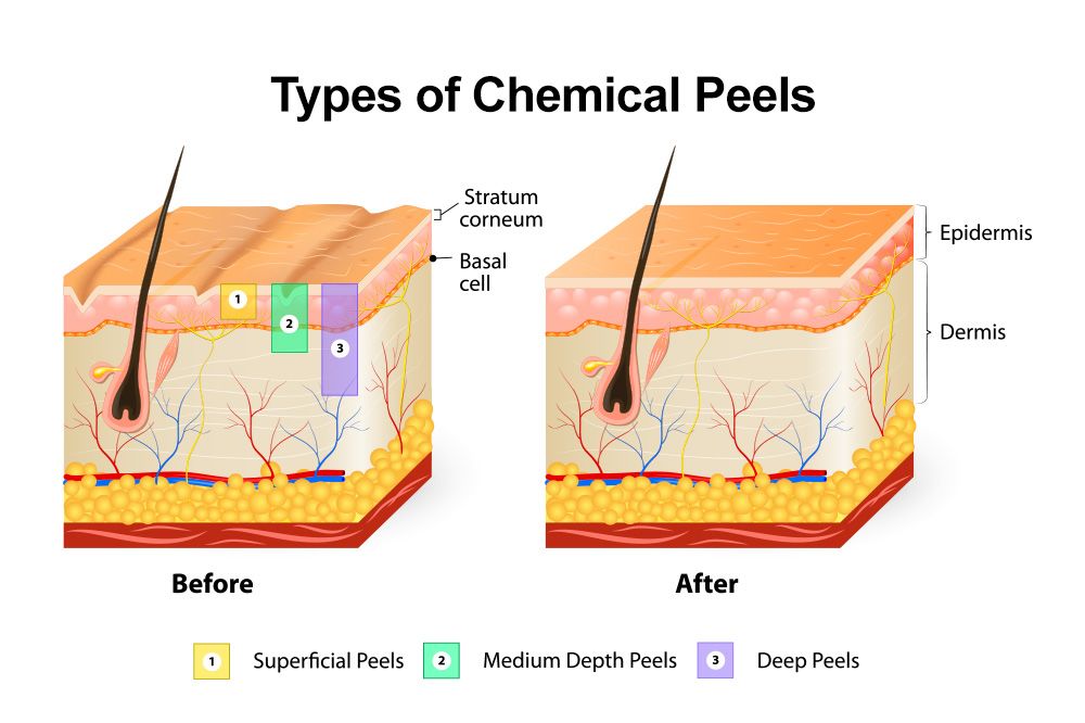 chemical peel effects
