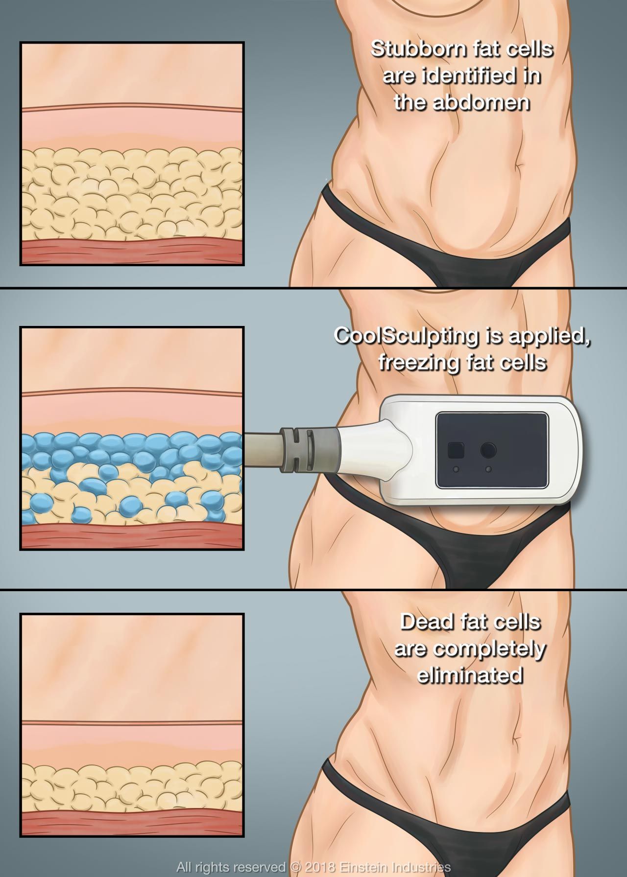 CoolSculpting procedure